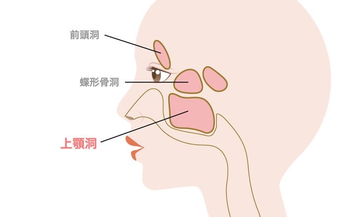 上顎洞炎のリスクがある