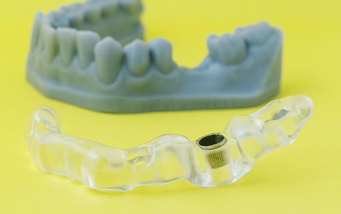 サージカルガイドを使ったインプラント治療の流れ：サージカルガイドの製作