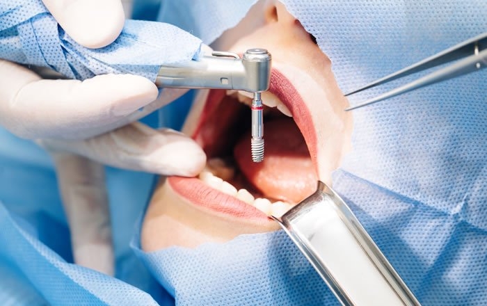 サージカルガイドのメリット：インプラント治療の精度の向上