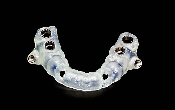 インプラント治療で使うサージカルガイドとは？