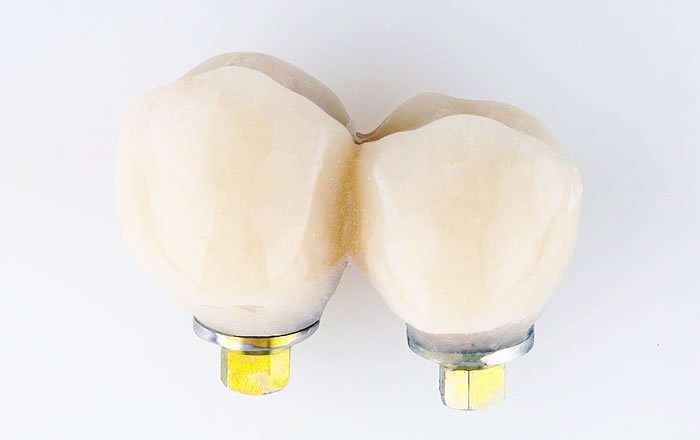 フラップレスインプラントのメリット：手術した日に仮歯が入れられる