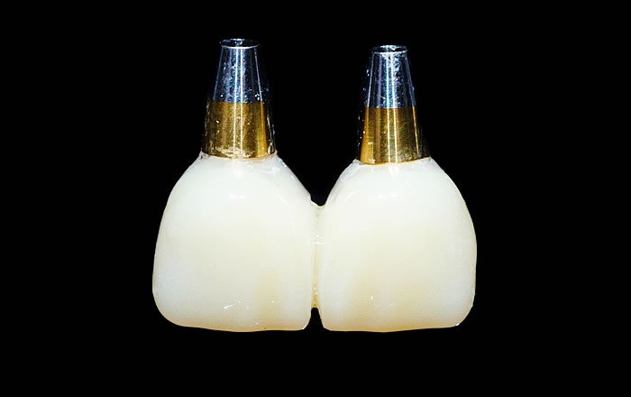 インプラントの傾斜埋入のメリット：仮歯をつけるのが早い