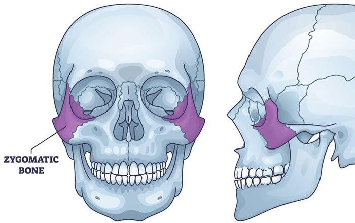 ザイゴマインプラントとは？