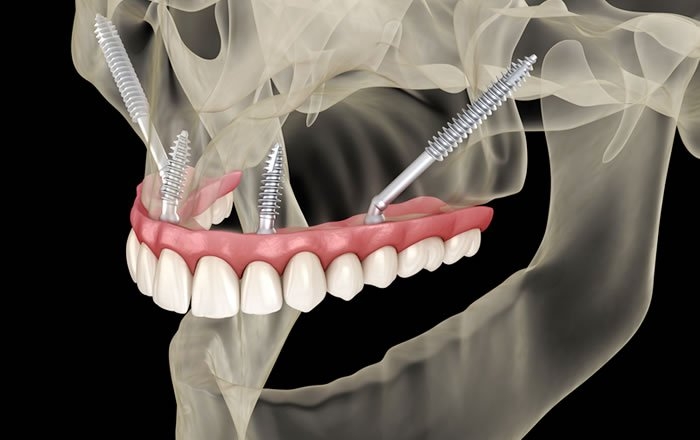ザイゴマインプラントと通常のインプラントとの違い