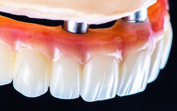 ザイゴマインプラントのメリット：固定式の歯になる