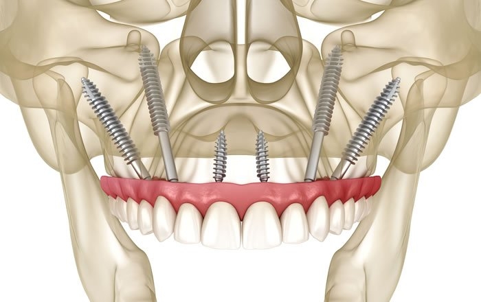頬骨を利用したザイゴマインプラント