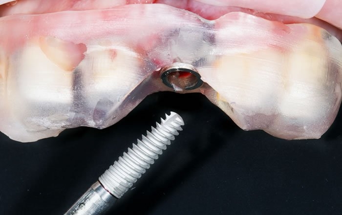 フラップレスインプラント治療の流れ：インプラントを埋め込む