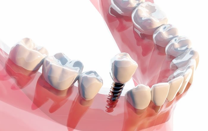 切らない縫わないインプラント治療、フラップレスインプラントとは？