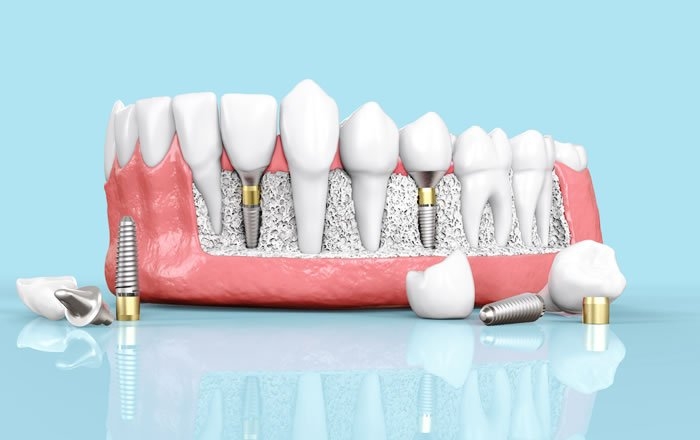 インプラントと骨の結合不全～オッセオインテグレーションが上手くいかない