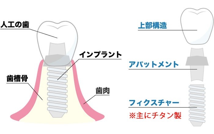 インプラント治療後、基本的にMRI検査は受けられる