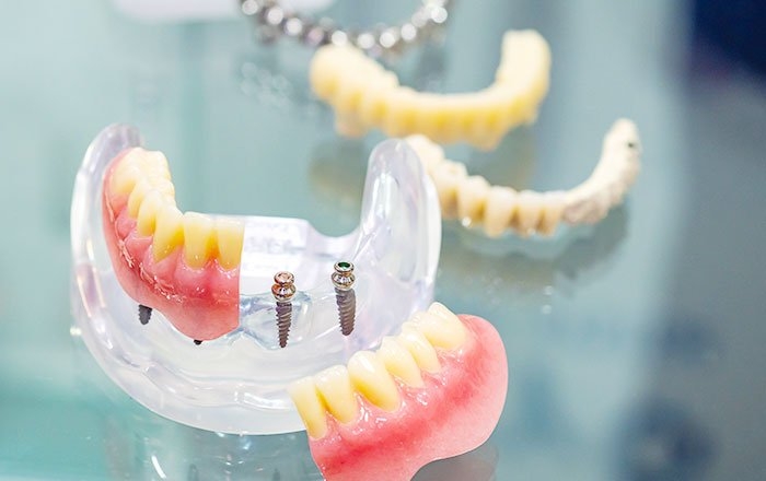 入れ歯にお悩みがある方はミニインプラント治療も候補に