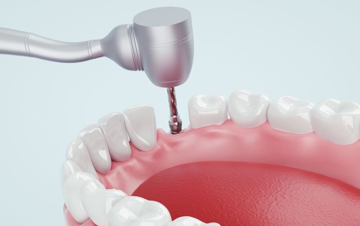 ミニインプラント治療のメリット：歯茎の切開がなく、インプラントの埋め込みが簡単