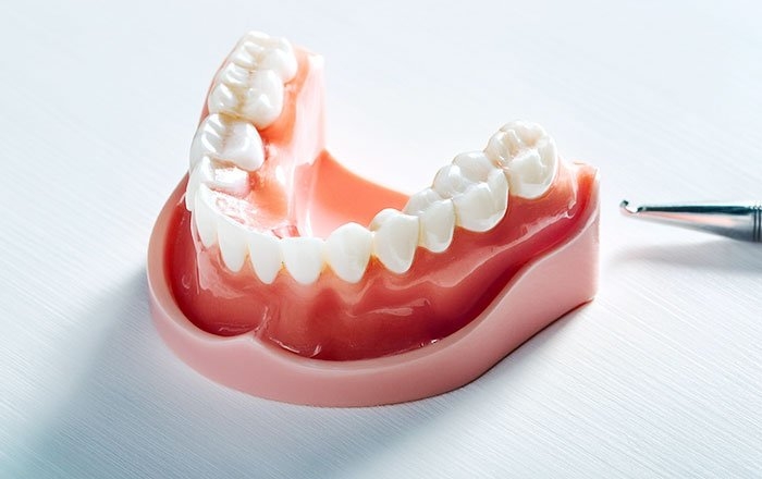 ミニインプラントのデメリット：基本的に下顎を対象としている