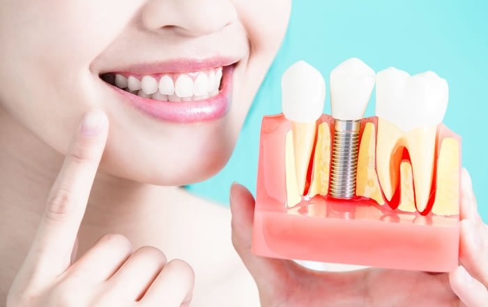 インプラントの特徴：仕上がりが美しい