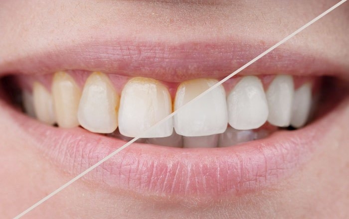 ホワイトニングとは