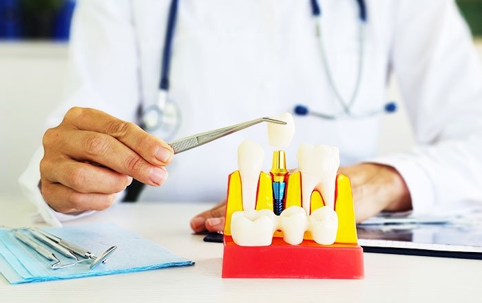 インプラントのやり直し（再治療）は可能？