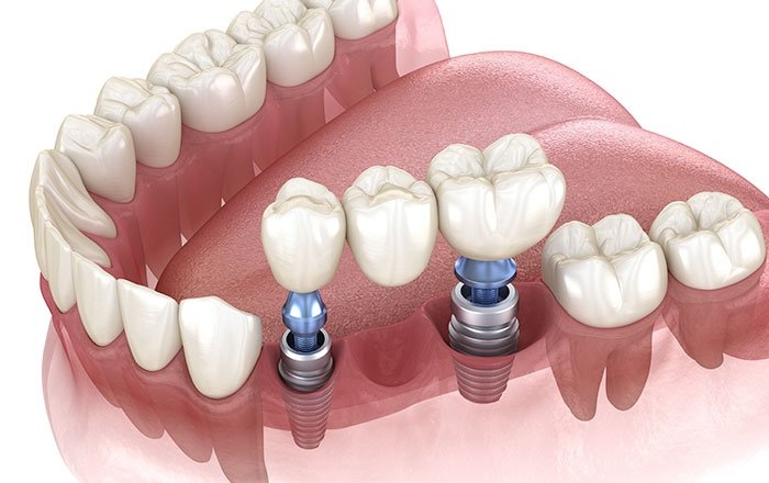 インプラントブリッジという選択肢も
