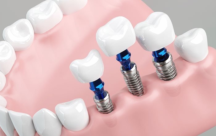 インプラントの相談（カウンセリング）でわかること：インプラント治療の方法