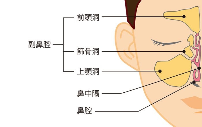 インプラント治療で頭痛が起こる理由:副鼻腔に炎症が起きるため