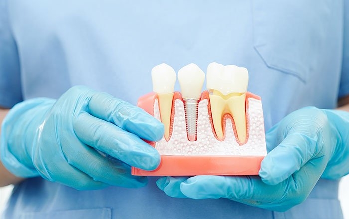 金属アレルギーの方にも安心なジルコニアインプラント