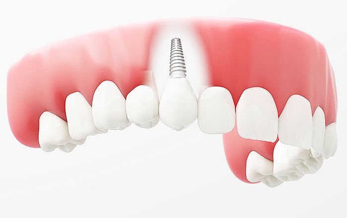 ジルコニアインプラントのメリット：生体親和性が高く、身体になじみやすい