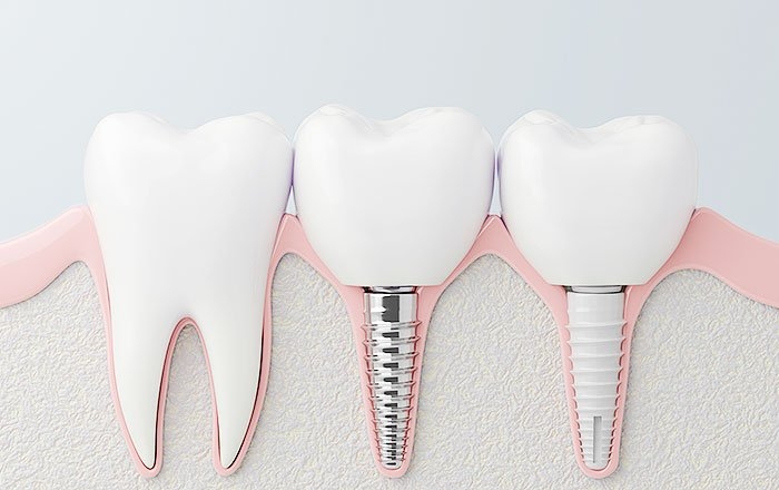 ジルコニアインプラントのメリット：骨との結合力に優れる