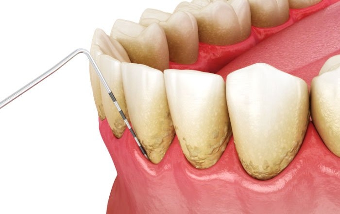 より成功率を下げるリスクの高い喫煙者：歯周病が進行している方