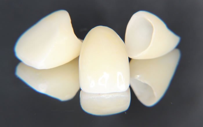 ジルコニアオールセラミッククラウン