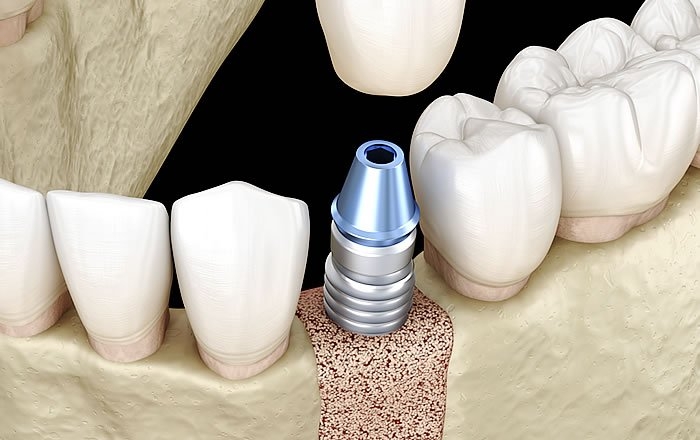 前歯にインプラントを入れる際の注意点：骨造成が必要になる場合がある