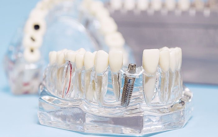 インプラントの間隔と位置の目安