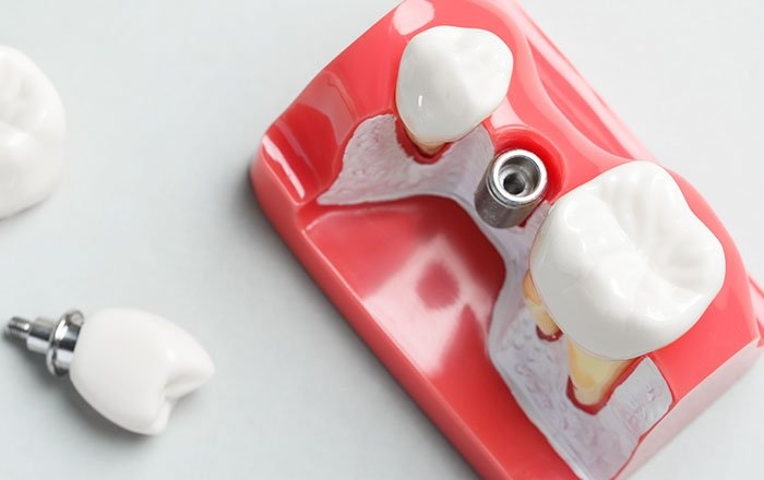 インプラント周囲の骨の厚さ