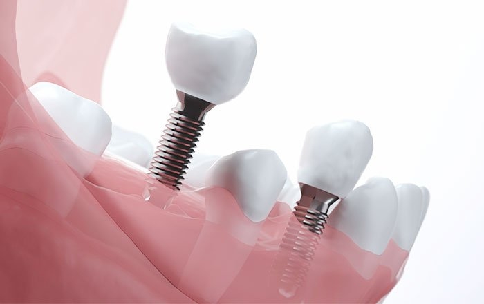 インプラントの深さ