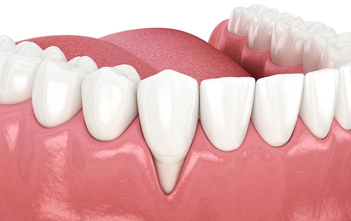 インプラントの間隔や位置が大切なのはどうして？：歯茎が下がることがあるため（歯肉退縮）