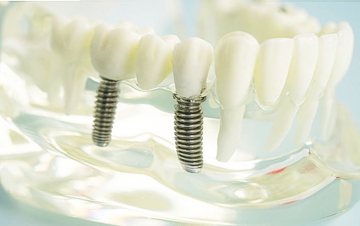 インプラント体（フィクスチャー）が外れてしまう原因：インプラントの埋入位置が良くない