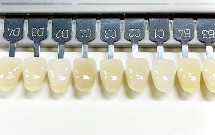 前歯部のインプラント治療は難しい理由：色の再現が難しい