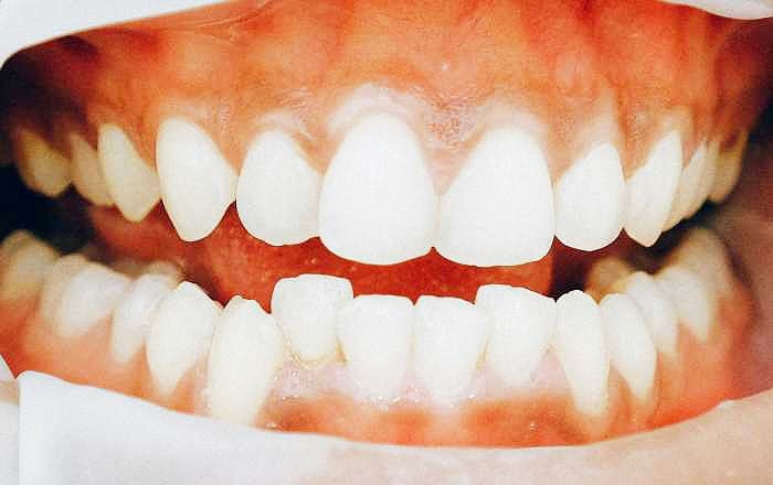 前歯部のインプラント治療は難しい理由：歯肉の形も再現する必要がある