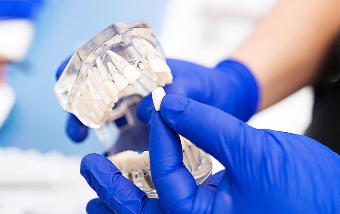 意外と難しい？前歯部のインプラント