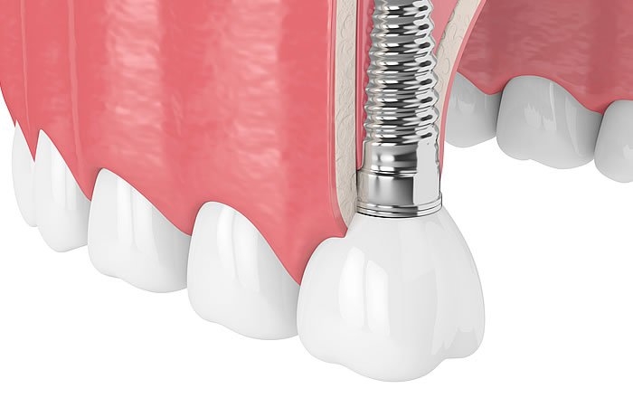 上顎の奥歯をインプラントにする時の注意点：上顎洞底（じょうがくどうてい）を傷つけるリスク