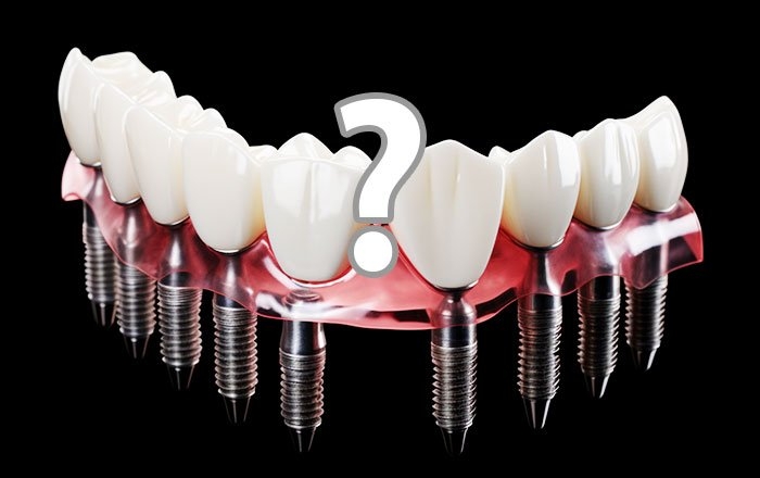 インプラントは何本までなら入れられる？
