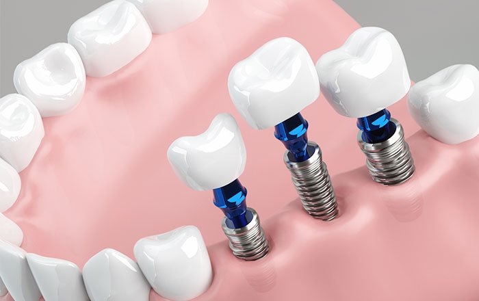 より現実的なインプラントの最大本数は