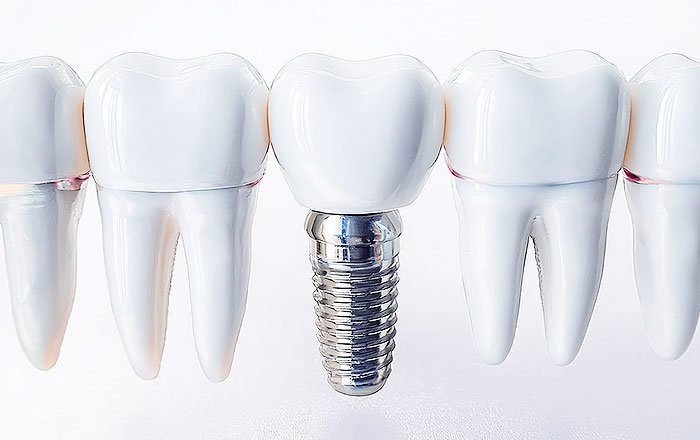 奥歯のインプラント治療のメリット：他の歯への負担が少ない