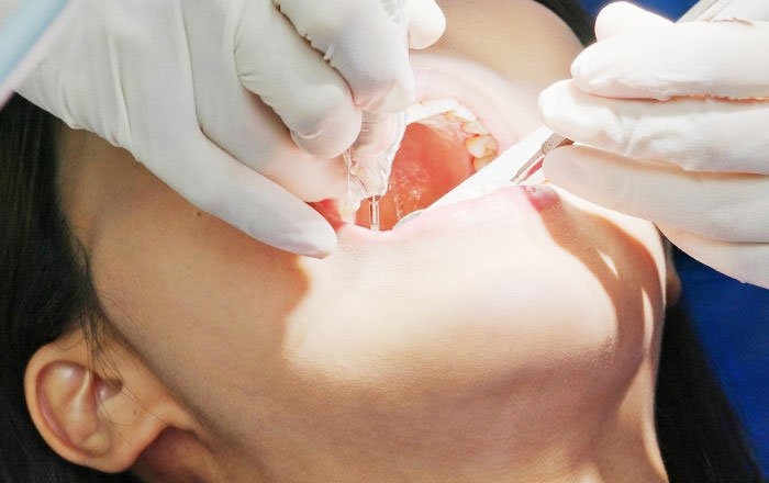 奥歯のインプラント治療の難点は？