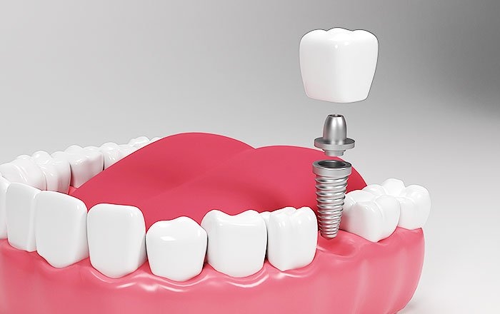 奥歯のインプラント治療～そのメリットと難点は？