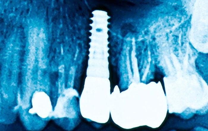 骨粗しょう症になるとインプラントと骨の結合が弱まる