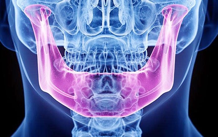 骨粗しょう症治療薬が顎骨壊死を引き起こす可能性がある