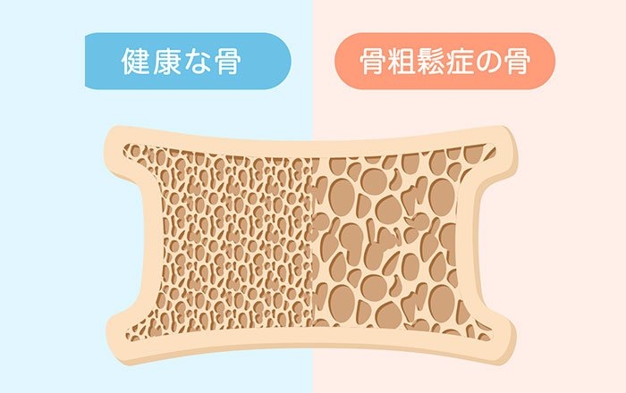 インプラントと骨の結合が弱まる原因は骨強度の低下
