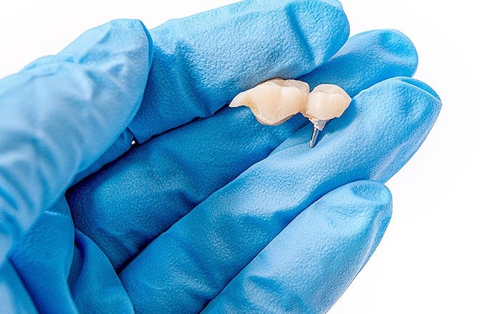 歯ぎしりがインプラントに及ぼす影響：上部構造の破損