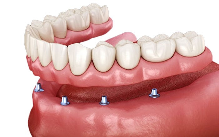 インプラントロケーターとは？