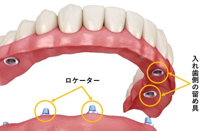 インプラントロケーターの構造