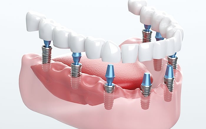 インプラントロケーターのメリット：通常のインプラントよりも負担が少ない